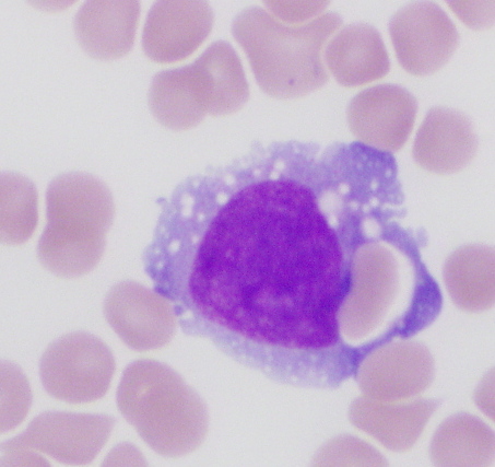 Fig. 5 Bone marrow aspirate. Blasts with delicate chromatin and prominent nucleoli (Fig. 5a). Many of the blasts/blast equivalents exhibited large folded or bizarre nuclei (Fig. 5b). There is abundant basophilic cytoplasm with cytoplasmic blebbing and extensive vacuolization (Fig. 5c). Prominent eosinophilic peri-nuclear hofs are present, which range in appearance from collections of eosinophilic granules (Fig. 5d) to collections of small vacuoles (Fig. 5e). Hemophagocytosis is also seen (Fig. 5f).